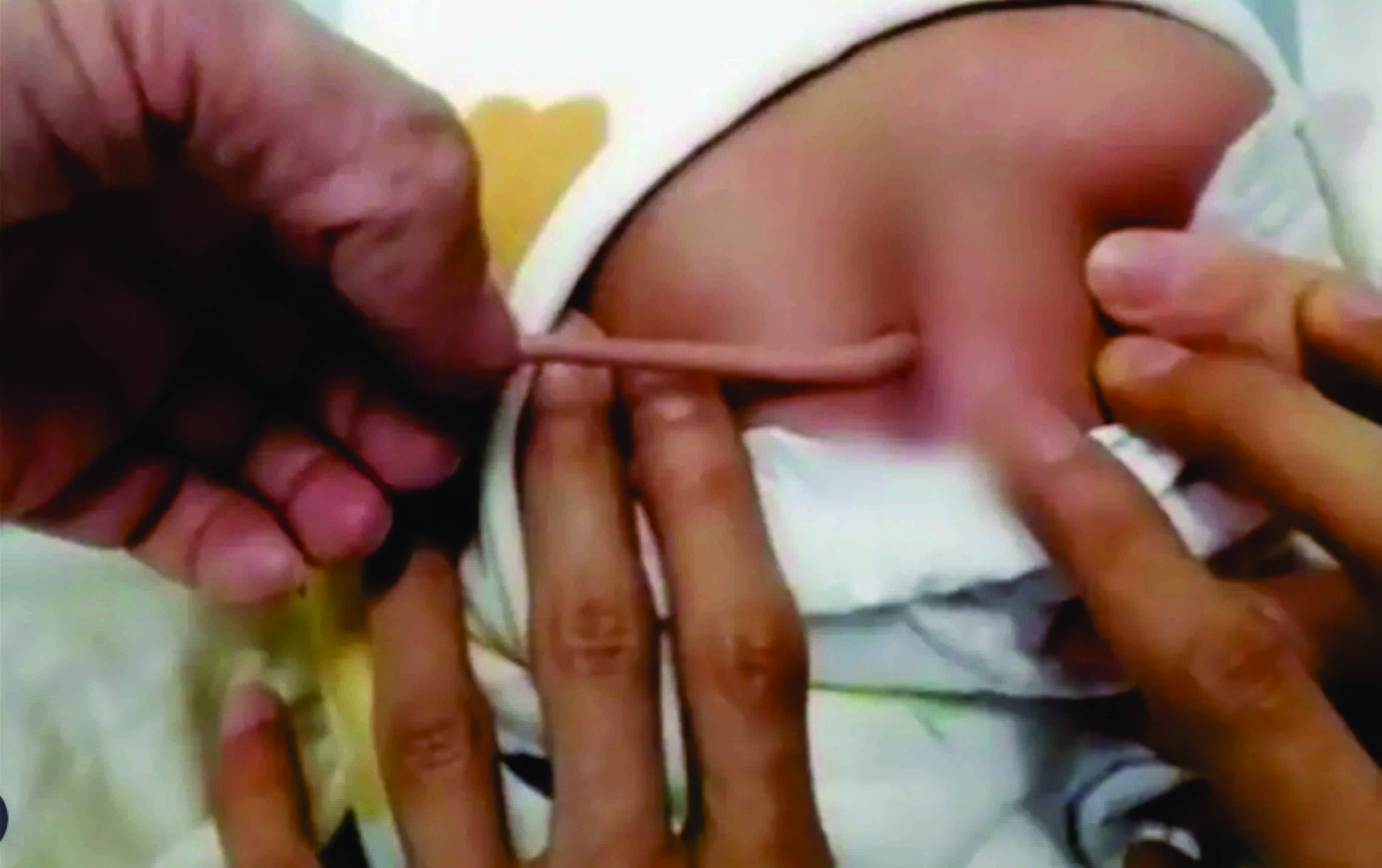 Bebê nasce com ‘cauda’ de 10 centímetros na China